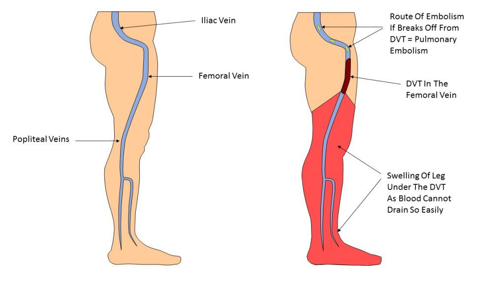 dvt prophylaxis