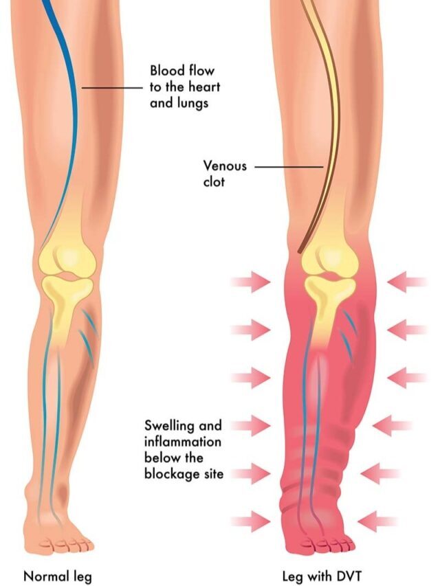 Symptoms of DVT (blood clot) in the leg you should not ignore!