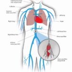 IVC Filter: Saddle pulmonary embolism