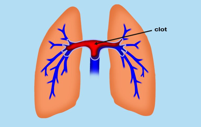 saddle pulmonary embolism