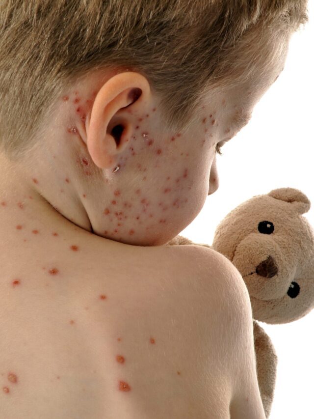 15 Astonishing Facts About Measles You Never Knew