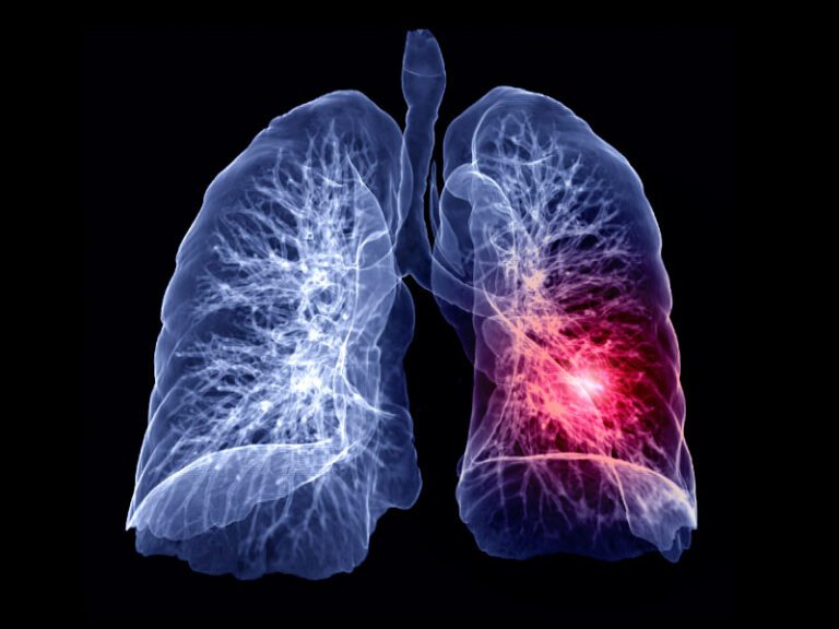 pulmonary embolism