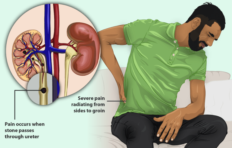 7mm Kidney Stone