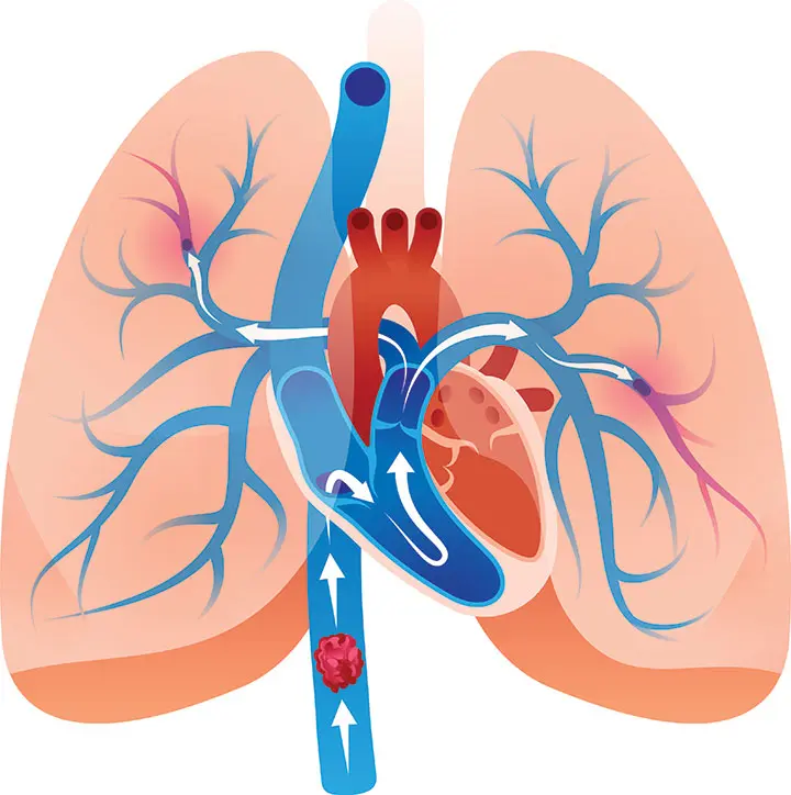 pulmonary embolism